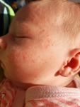 Высыпания на лице новорожденного фото 3