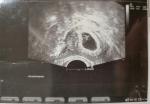 Патология эмбриона фото 1
