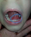 Воспаление или нарост под языком фото 1