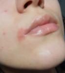 Покраснение и шелушение вокруг губ фото 1