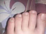 Болит ногтевая пластина на пальце ноги фото 2