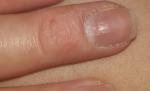 Отек пальца длительное время, деформация ногтя фото 4
