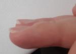 Отек пальца длительное время, деформация ногтя фото 3