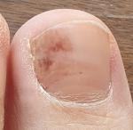 Меланома ногтя или травма? фото 1