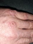 Болячки на суставах пальцев фото 2