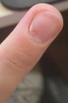 Проблема с ногтем в зоне кутикулы (деформация и белое пятно) фото 1