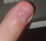 Проблема с ногтем в зоне кутикулы (деформация и белое пятно) фото 2
