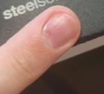 Проблема с ногтем в зоне кутикулы (деформация и белое пятно) фото 3