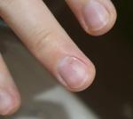 Проблема с ногтем в зоне кутикулы (деформация и белое пятно) фото 4
