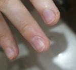 Проблема с ногтем в зоне кутикулы (деформация и белое пятно) фото 5