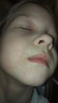 Герпетическая сыпь на лице у ребёнка фото 1