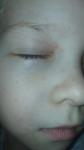 Герпетическая сыпь на лице у ребёнка фото 2