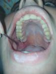 Острая боль возле последнего верхнего зуба фото 1