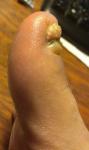 Ноготь после перелома пальца фото 2