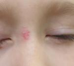 Розовое пятно на лице у ребенка фото 1