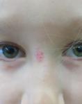 Розовое пятно на лице у ребенка фото 2