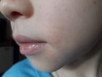Сыпь вокруг рта у ребенка фото 3