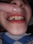Пятна-налет на передних зубах фото 1