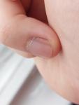 Меланома или нет полоска на ногте? Помогите пожалуйста фото 2