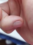 Меланома или нет полоска на ногте? Помогите пожалуйста фото 1