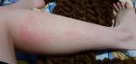 Сыпь на ногах, аллергия фото 1