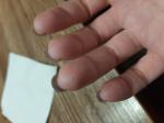 Пятнышки на подушечке пальца руки фото 2