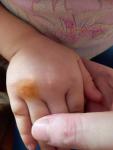 У ребенка круглое пятно на руке фото 1