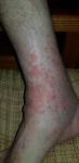 Аллергия кожный зуд фото 2