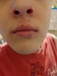 Мелкие прыщики на носу и шелушение губ фото 1