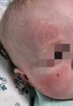 Сыпь у ребенка 3 месяца фото 1