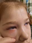 Трещина и покраснение под глазом у ребёнка фото 2