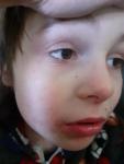 Срочно помогите, сыпь на лице у ребенка фото 1