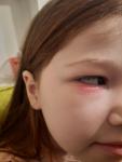 Трещина и покраснение под глазом у ребёнка фото 1