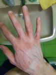 Воспаление на руке фото 3