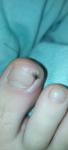 Инфекция или гноения кожи вокруг ногтя фото 1