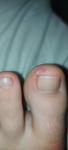 Инфекция или гноения кожи вокруг ногтя фото 3
