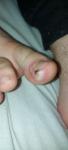 Инфекция или гноения кожи вокруг ногтя фото 2