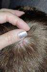 Папилломы волосистой части головы фото 1