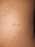 Сыпь на теле ребенка 8 лет (много, но не зудит) фото 2
