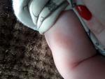 Шершавые пятнышки на ручках у малыша фото 1