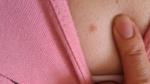 Розовое пятно на груди (не чешется, не болит) фото 1
