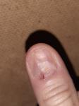 Болезнь ногтя, можно вылечить? фото 1