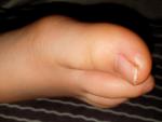 Белые образования на больших пальцах ног у ребенка фото 3