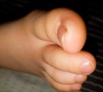Белые образования на больших пальцах ног у ребенка фото 2