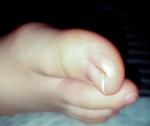 Белые образования на больших пальцах ног у ребенка фото 1