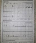 Расшифровка холтера при диагнозе мерцательная аритмия фото 4