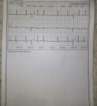 Расшифровка холтера при диагнозе мерцательная аритмия фото 3
