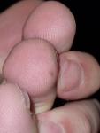 Пятно на среднем пальце ноги фото 1