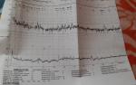 Результаты КТГ в 35 недель фото 1