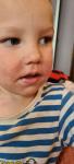 Шелушащиеся высыпания на лице ребенка фото 2